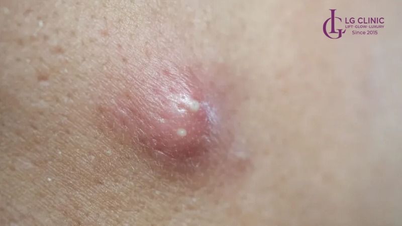 Mụn bọc ở lưng