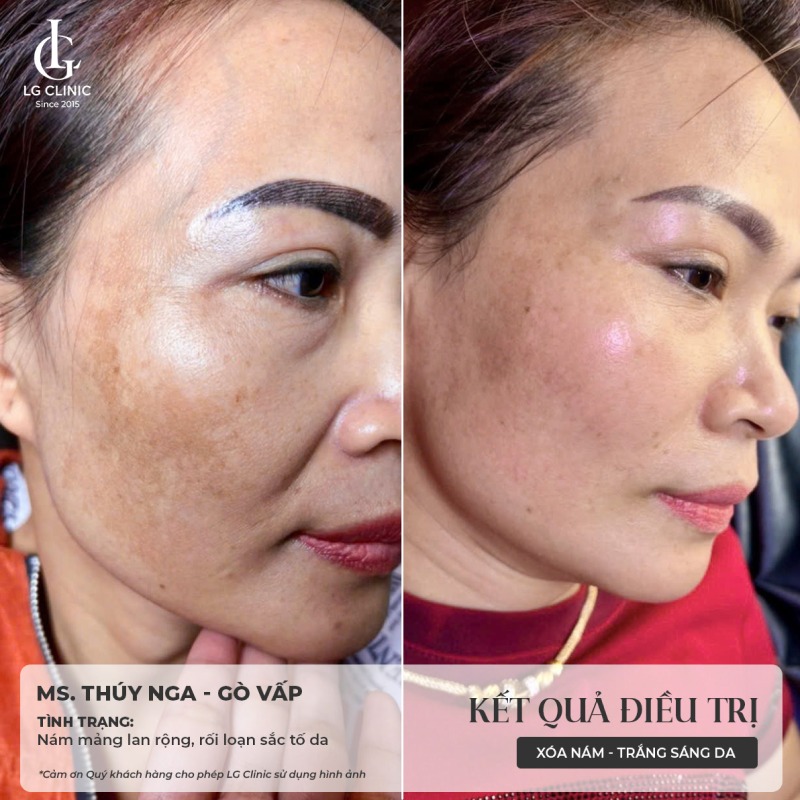 trị nám ở đâu tốt