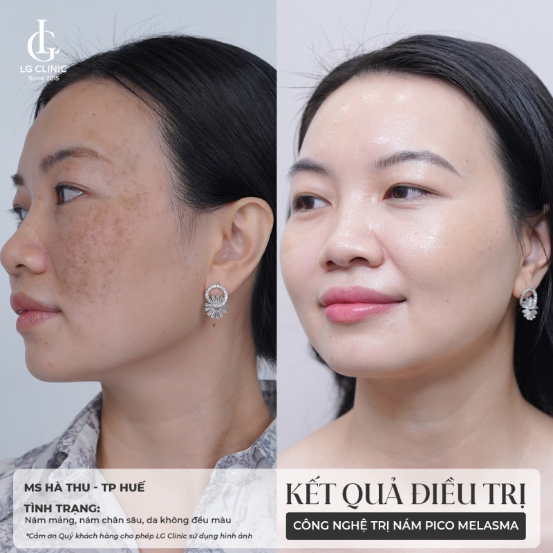 trị nám ở đâu tốt