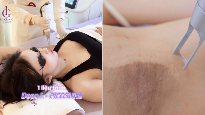 trị thâm nách mất bao lâu