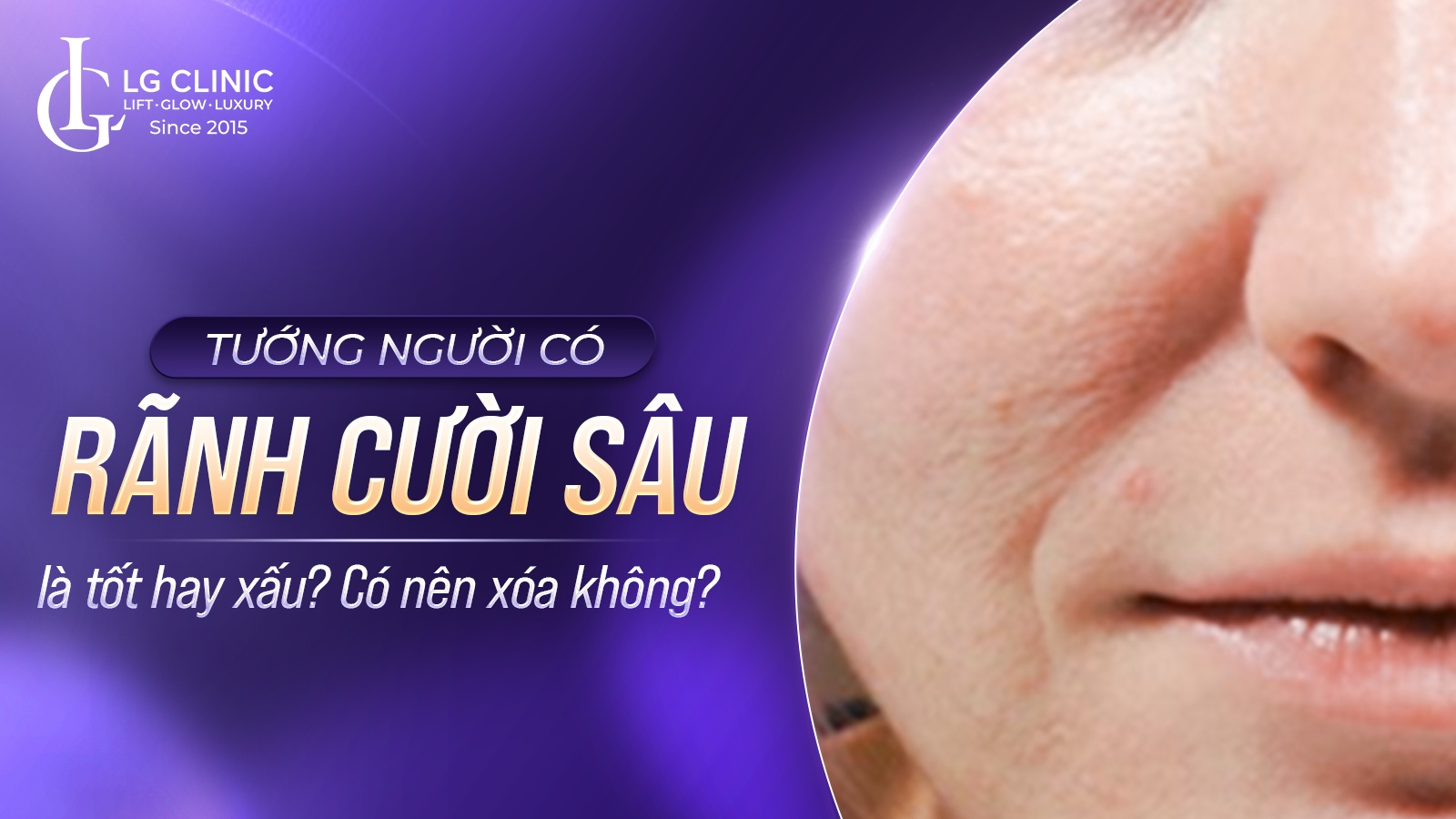 Tướng người có rãnh cười sâu là tốt hay xấu? Có nên xóa không?
