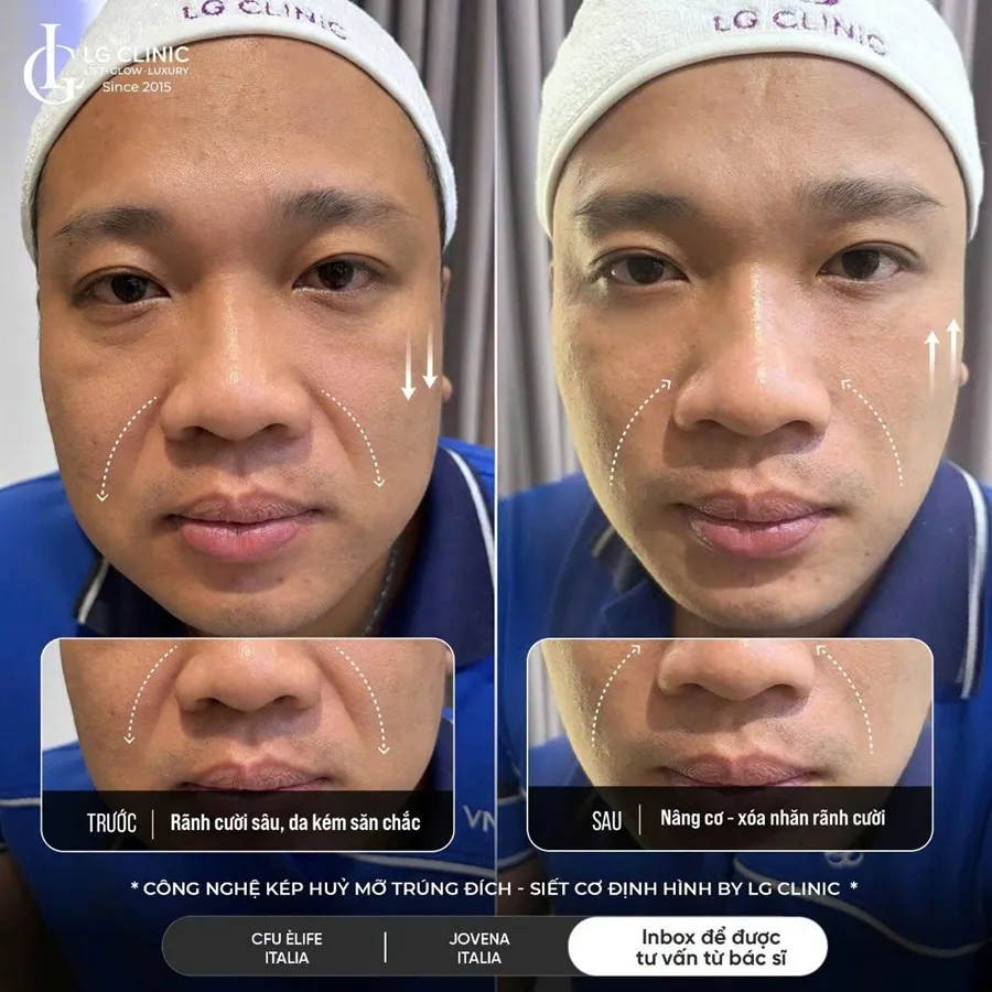 Ảnh BA công nghệ kép