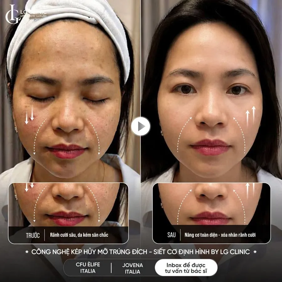 Ảnh BA công nghệ kép