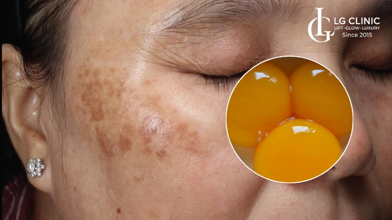 Cách dùng mặt nạ lòng đỏ trứng gà trị nám