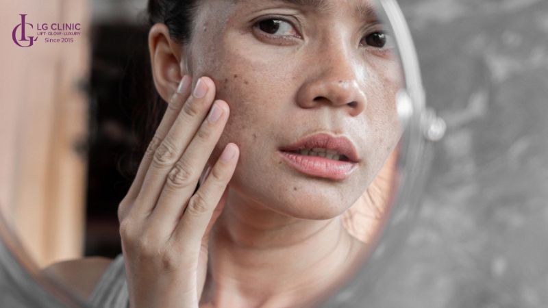 cách trị nám cho bà bầu