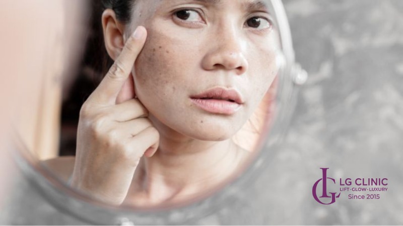 cách trị nám sau sinh