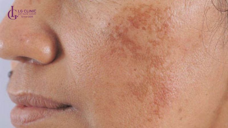 cách trị nám tại nhà