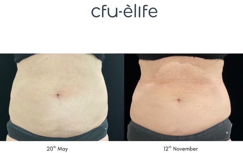 giảm béo không xâm lấn bằng cfu èlife