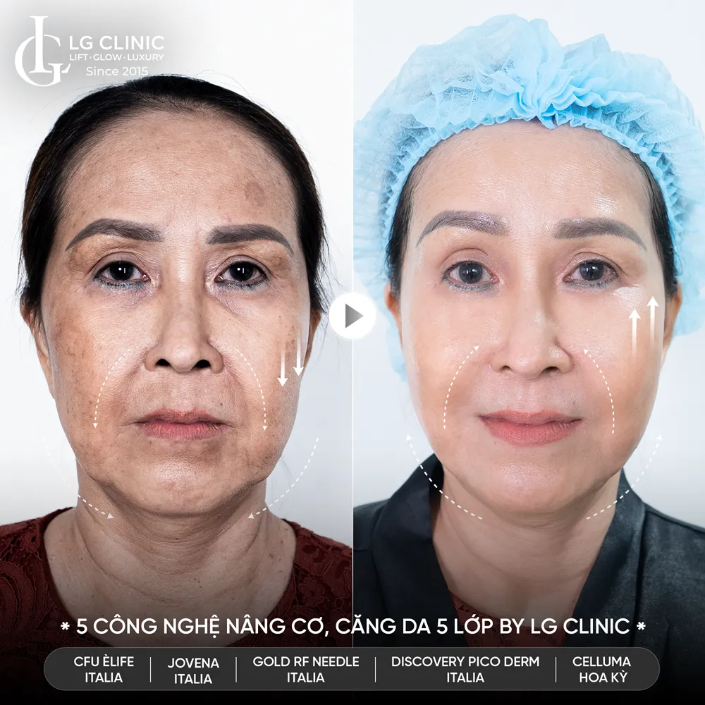 hình ảnh trước sau công nghệ 5510
