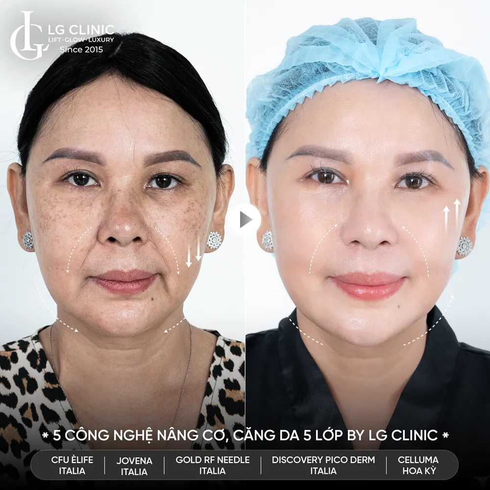 hình ảnh trước sau công nghệ 5510