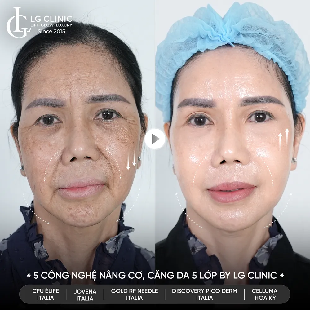 hình ảnh trước sau công nghệ 5510