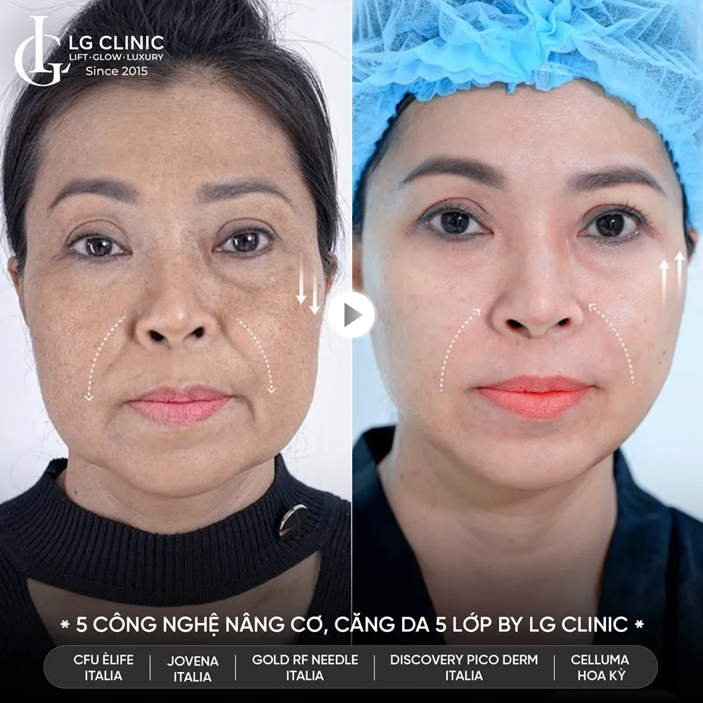 hình ảnh trước sau công nghệ 5510