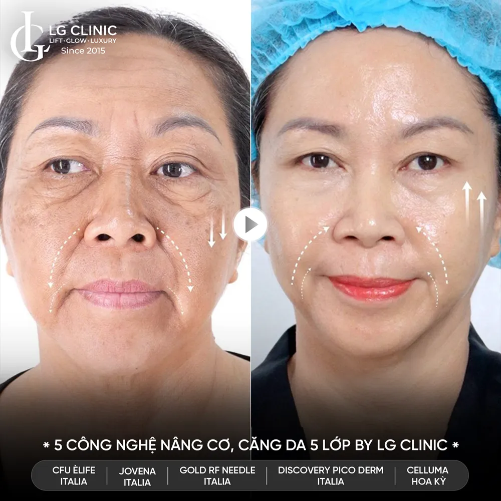 hình ảnh trước sau công nghệ 5510