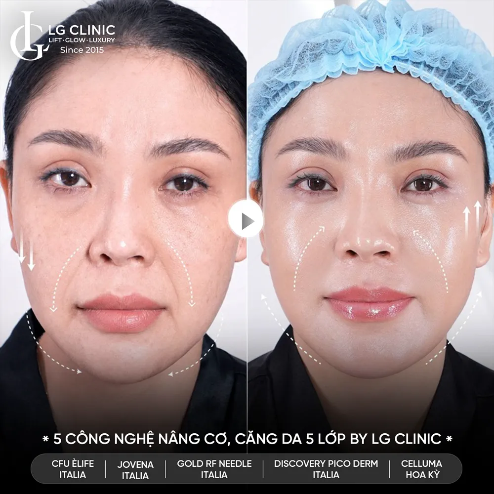 hình ảnh trước sau công nghệ 5510