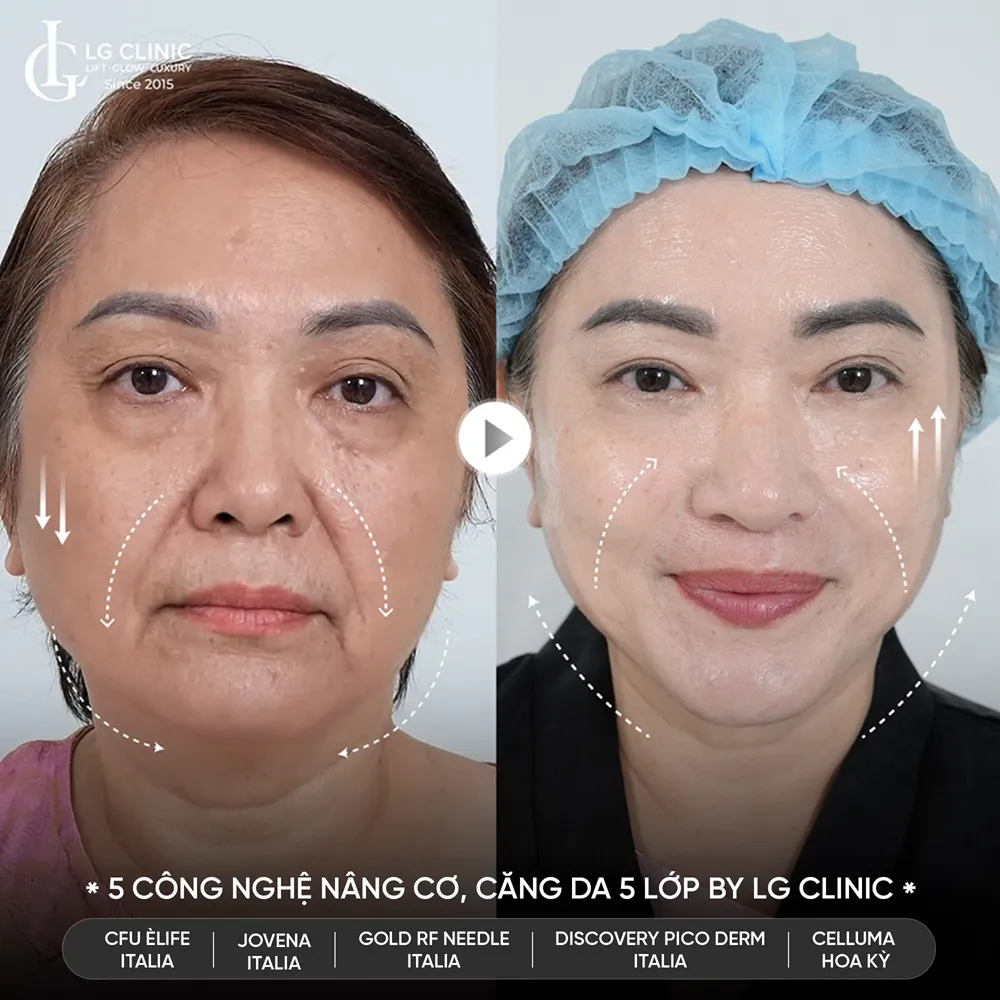 hình ảnh trước sau công nghệ 5510