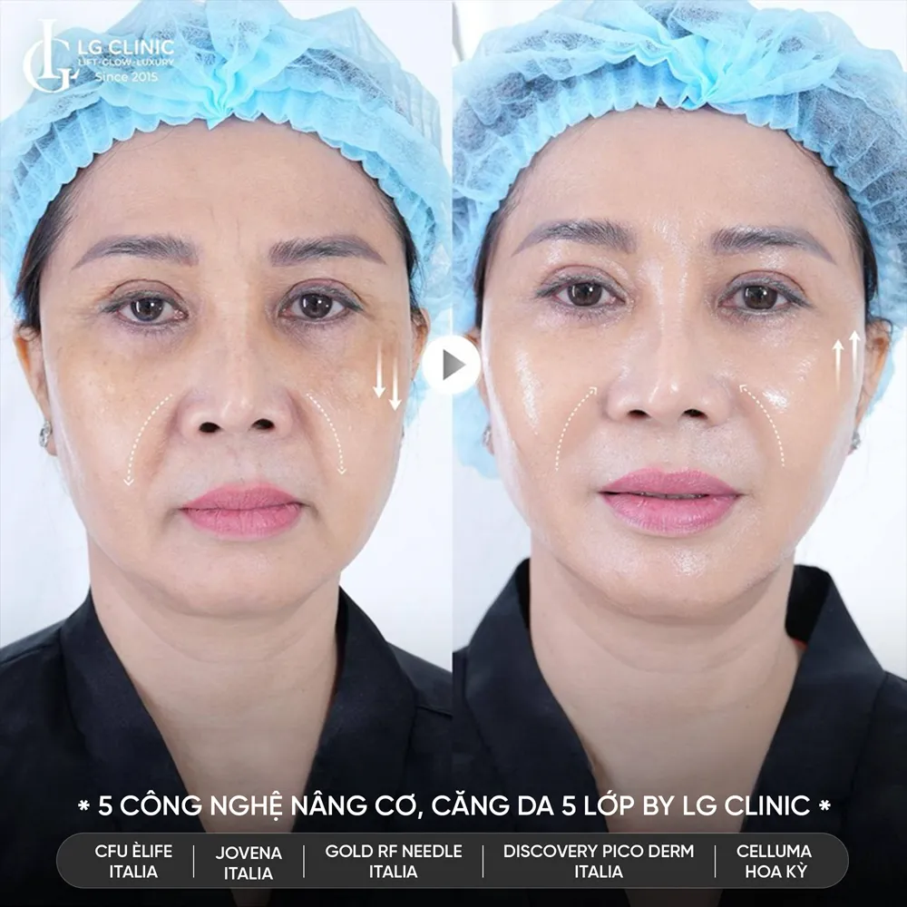 hình ảnh trước sau công nghệ 5510