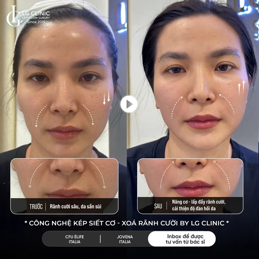 hình ảnh before-after công nghệ kép