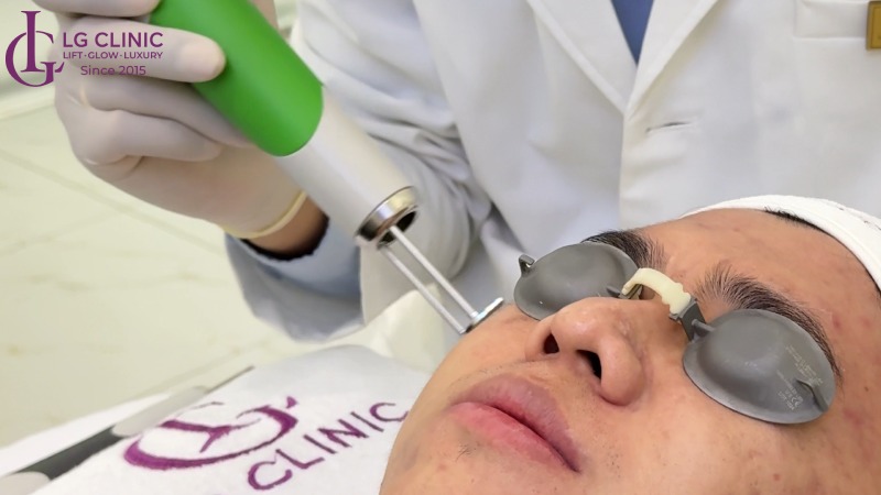 laser pico có bỏng da không