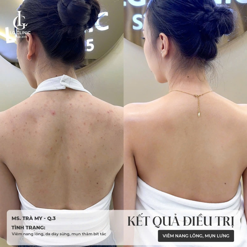 mụn trứng cá ở lưng 