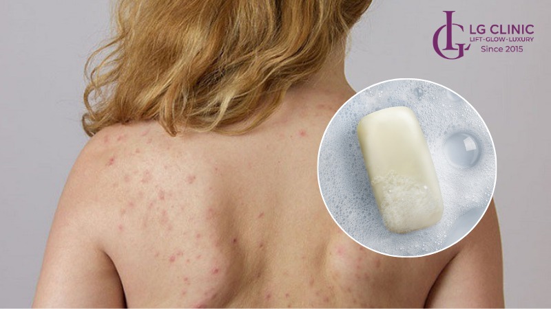 xà phòng trị mụn lưng tốt nhất
