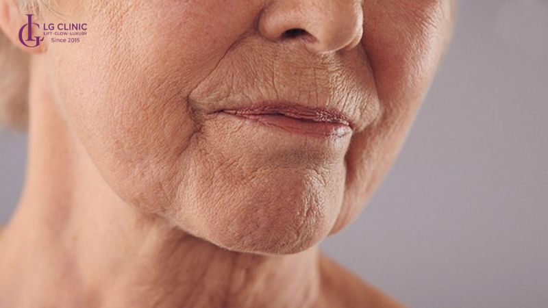 Khi đến độ tuổi trung niên thì da sẽ chùng nhão và chảy xệ rõ rệt hơn