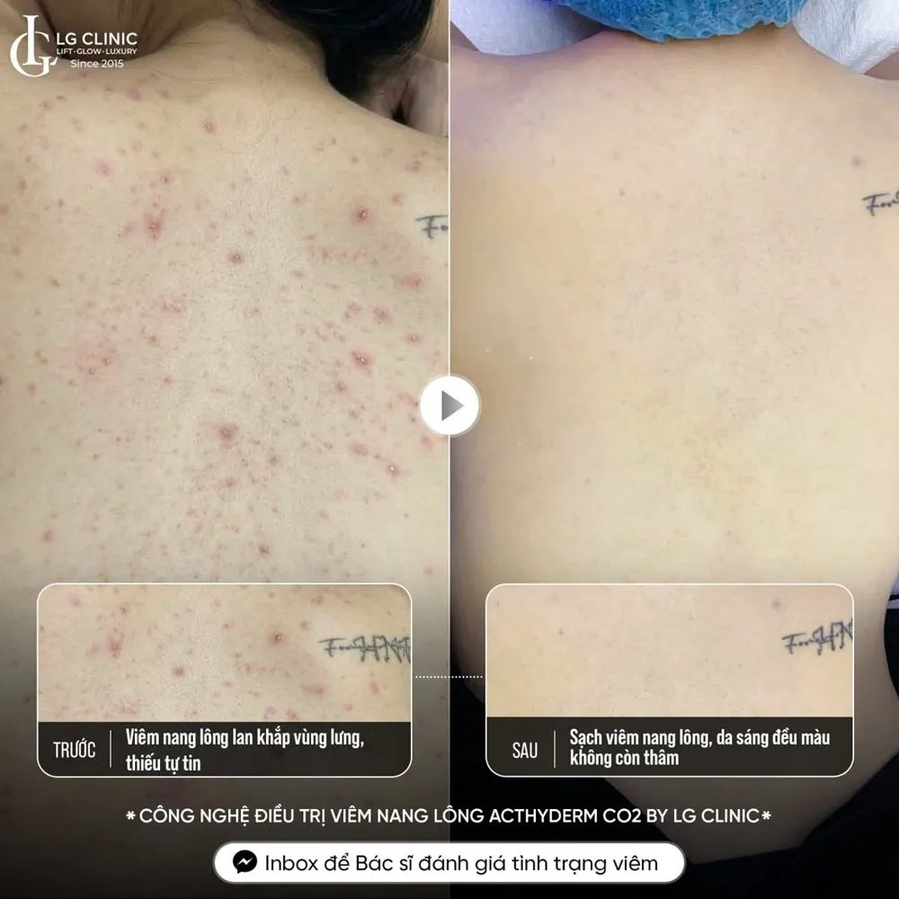 Hình ảnh ba mụn lưng viêm nang lông