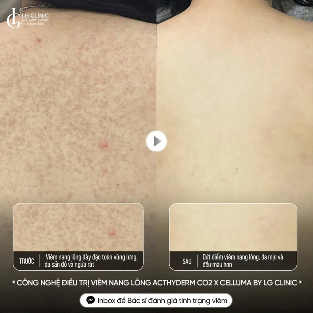 Hình ảnh ba mụn lưng viêm nang lông