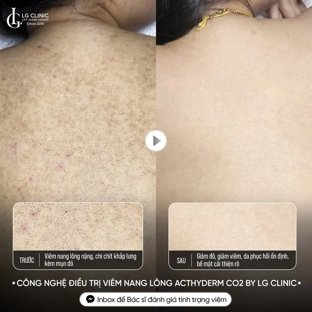 Hình ảnh ba mụn lưng viêm nang lông