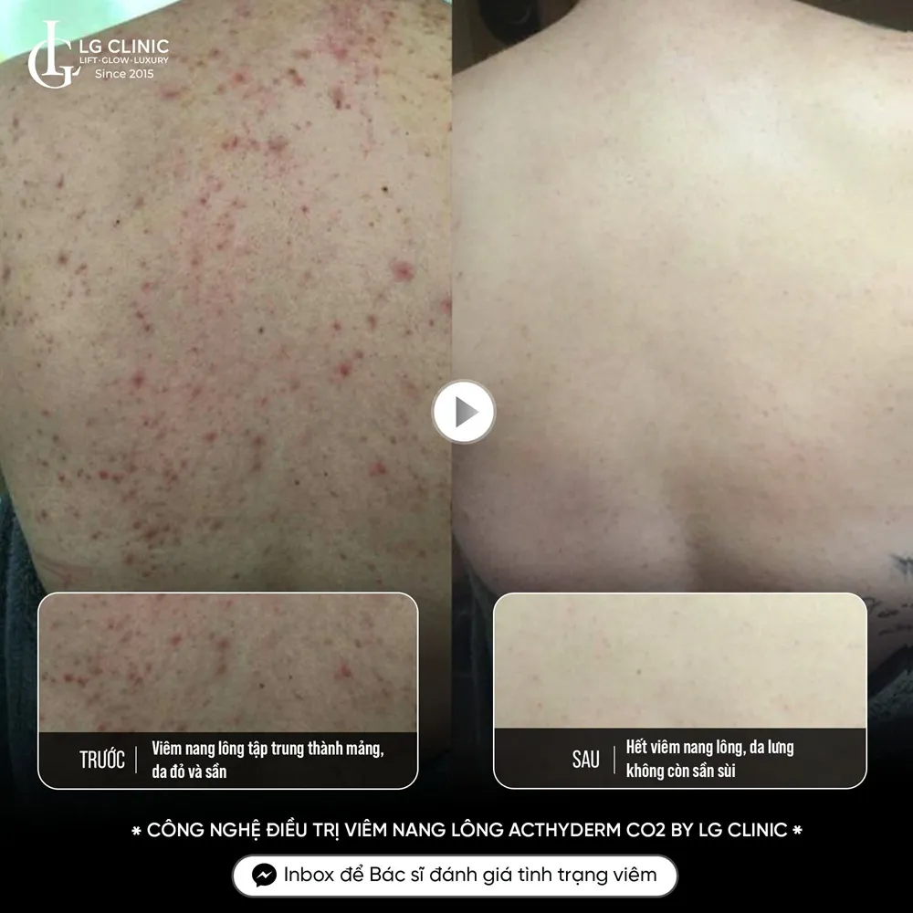 Hình ảnh ba mụn lưng viêm nang lông