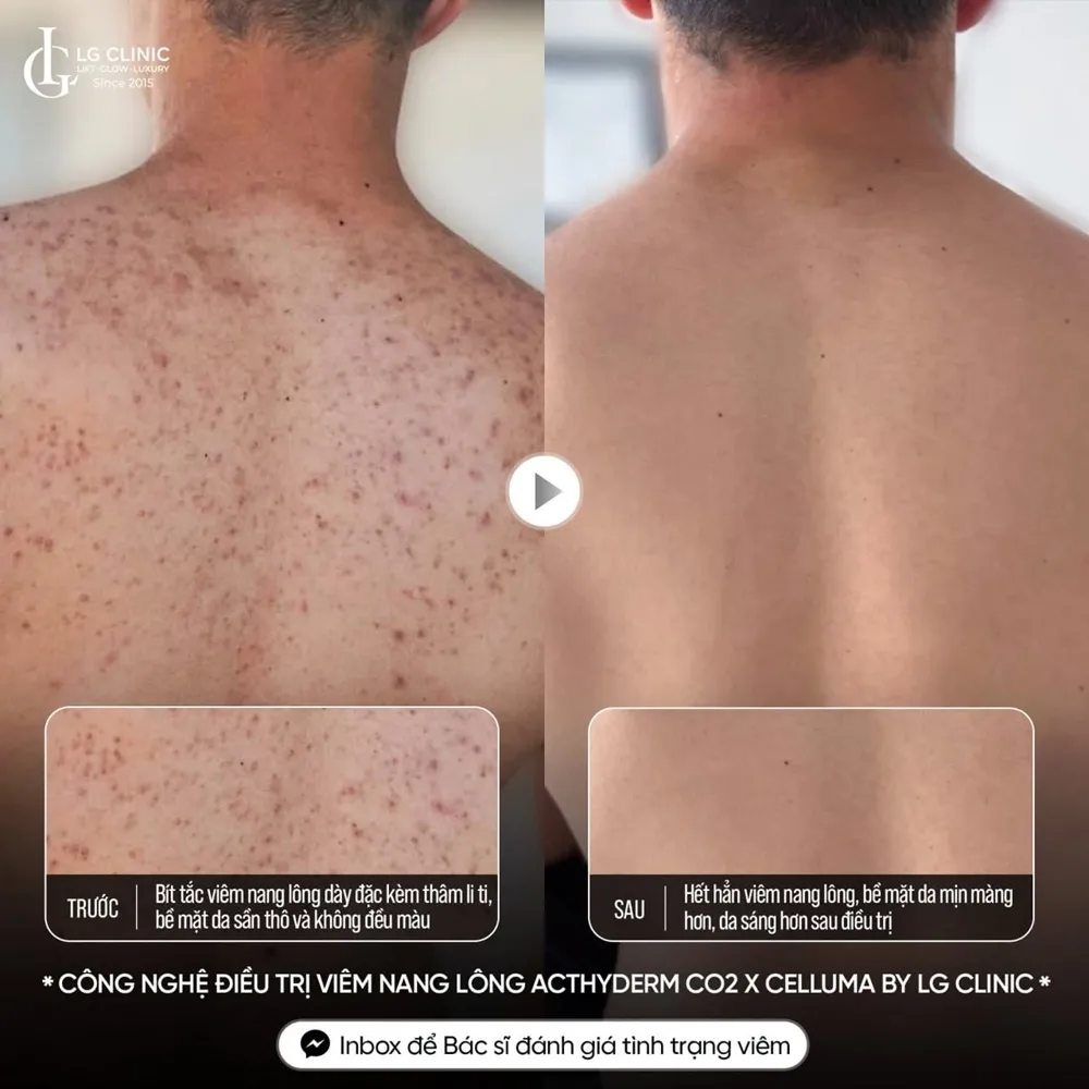 Hình ảnh ba mụn lưng viêm nang lông