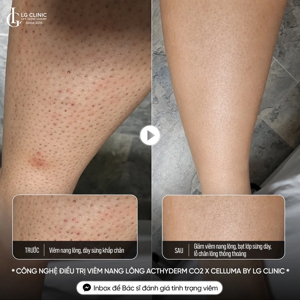 Hình ảnh ba mụn lưng viêm nang lông