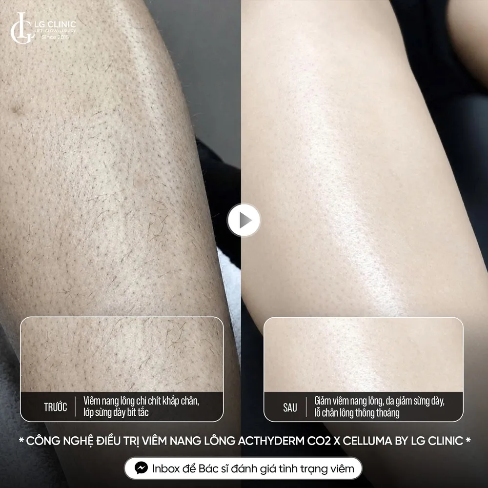Hình ảnh ba mụn lưng viêm nang lông