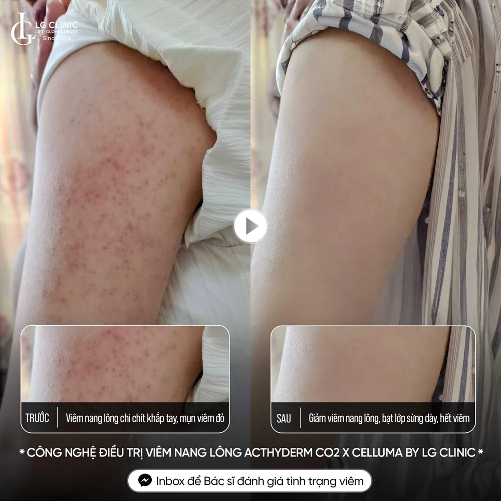 Hình ảnh ba mụn lưng viêm nang lông