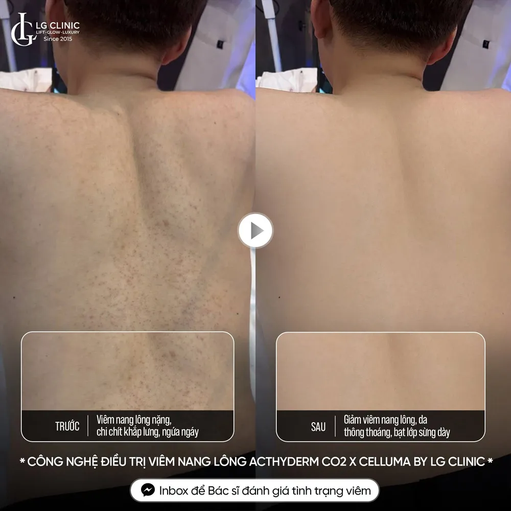 Hình ảnh ba mụn lưng viêm nang lông