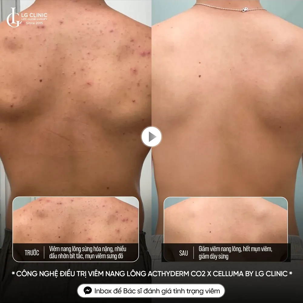 Hình ảnh ba mụn lưng viêm nang lông