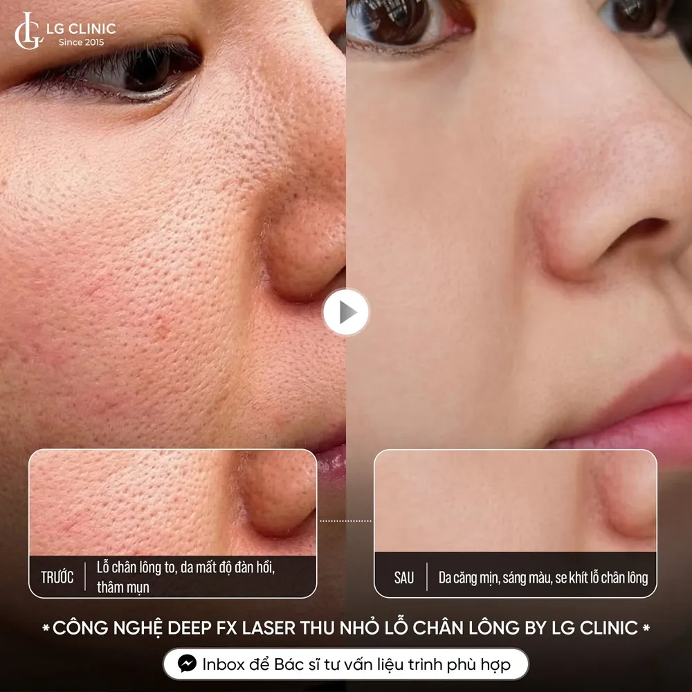 hình ảnh ba thu nhỏ lỗ chân lông