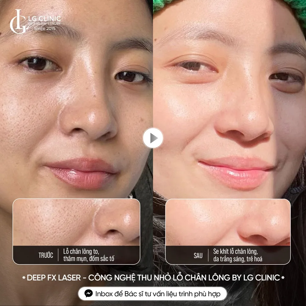 hình ảnh ba thu nhỏ lỗ chân lông