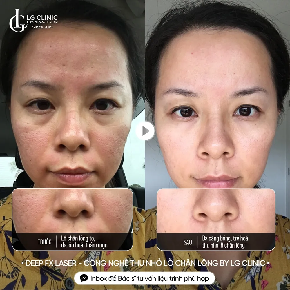 hình ảnh ba thu nhỏ lỗ chân lông