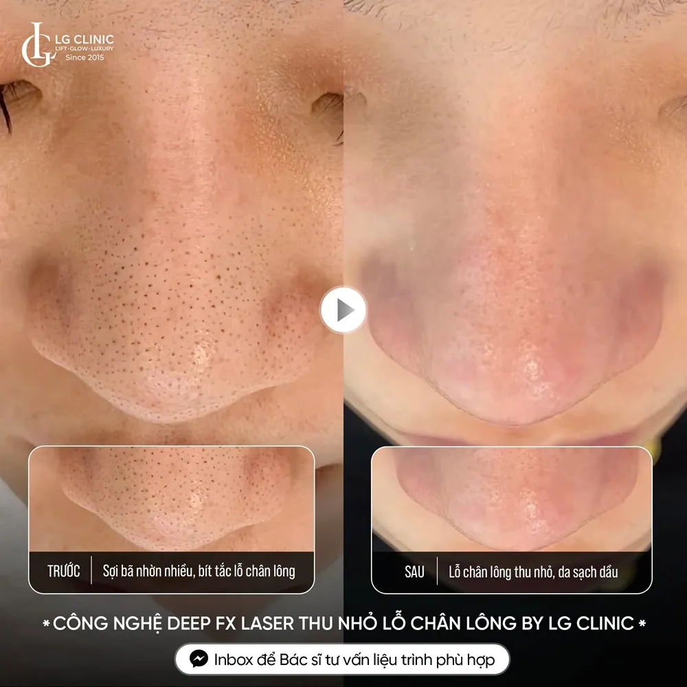 hình ảnh ba thu nhỏ lỗ chân lông