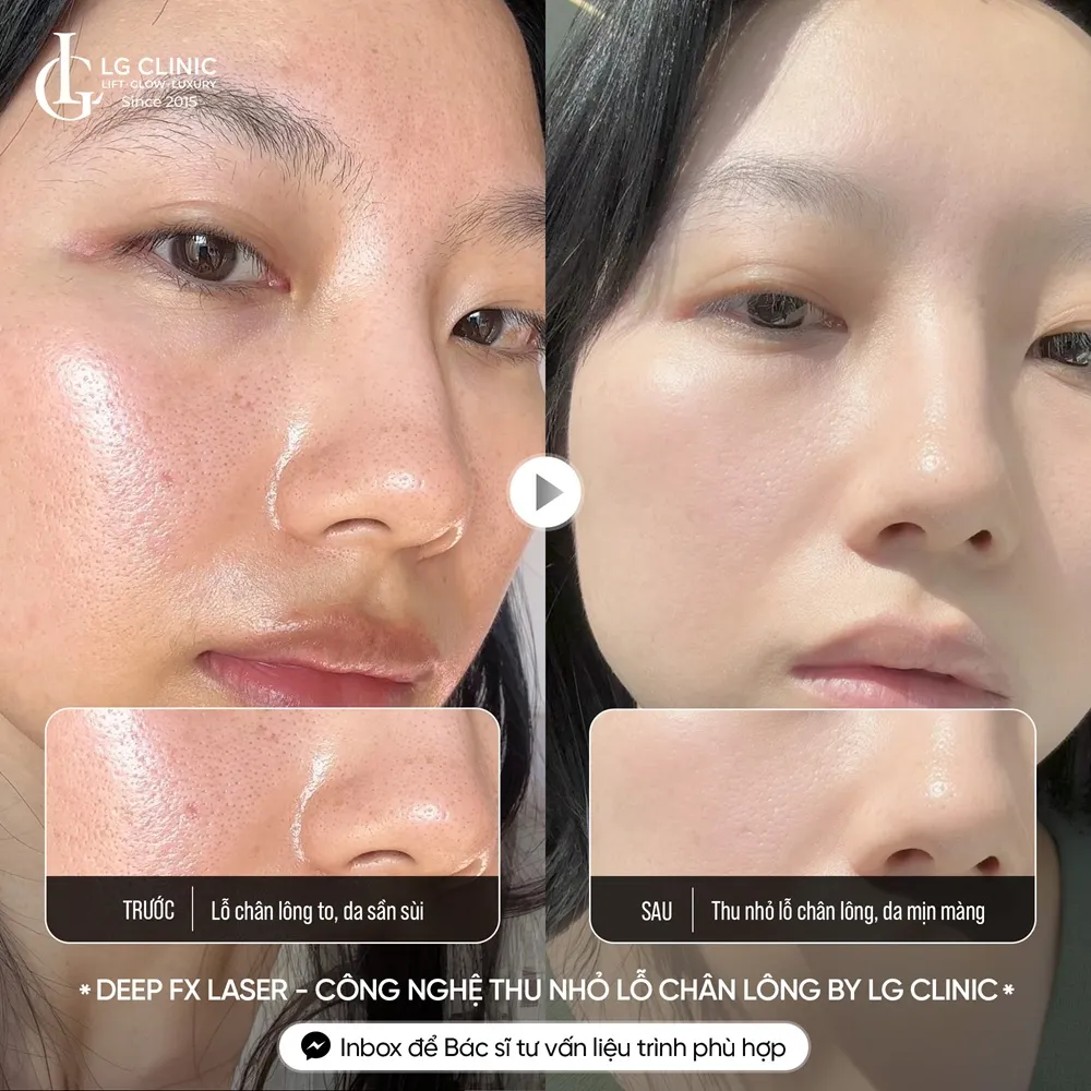 hình ảnh ba thu nhỏ lỗ chân lông