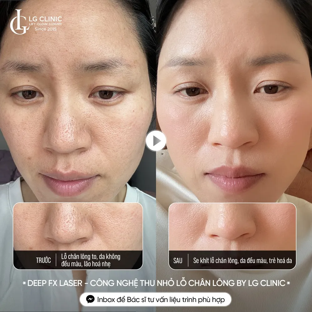 hình ảnh ba thu nhỏ lỗ chân lông