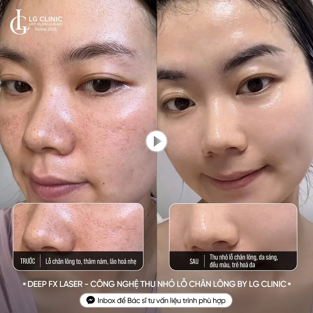 hình ảnh ba thu nhỏ lỗ chân lông