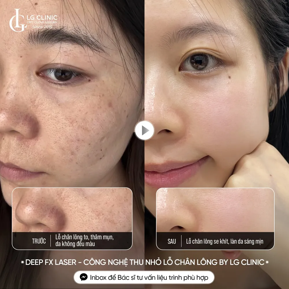 hình ảnh ba thu nhỏ lỗ chân lông