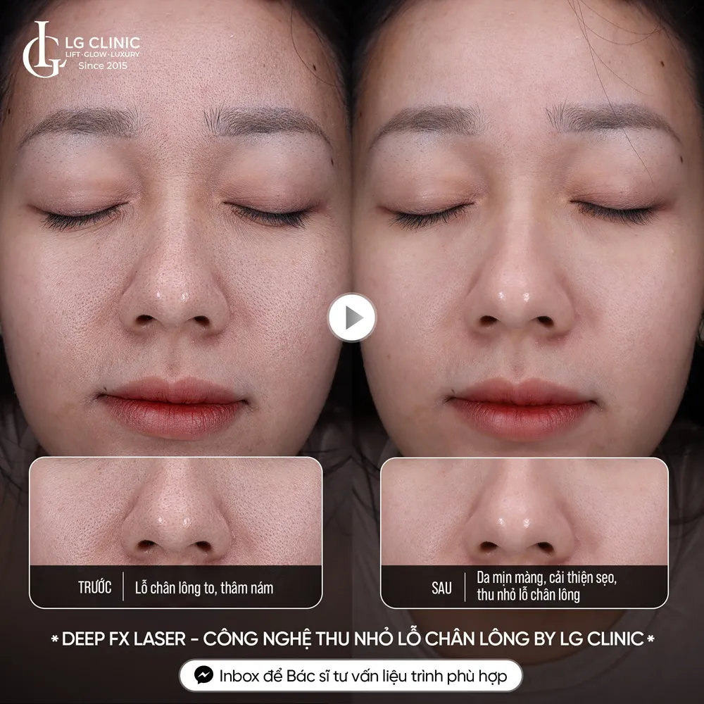 hình ảnh ba thu nhỏ lỗ chân lông