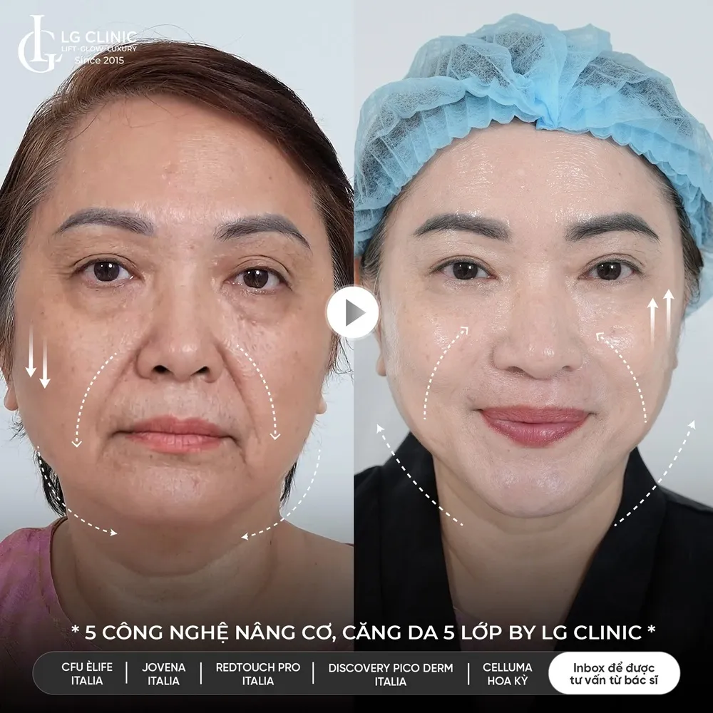Hình ảnh ba trẻ hóa khuôn mặt