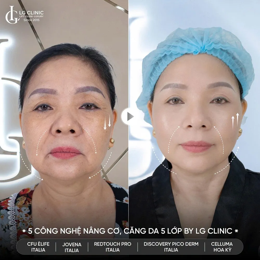 Hình ảnh ba trẻ hóa khuôn mặt