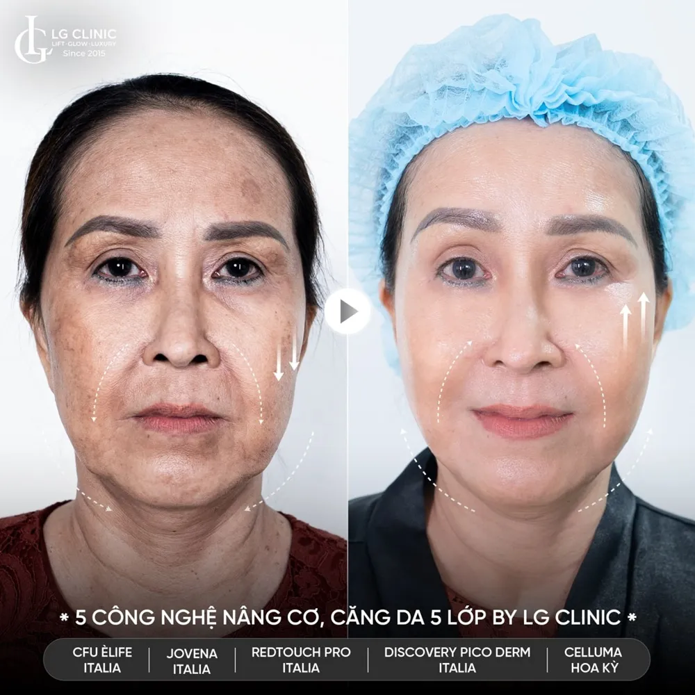 Hình ảnh ba trẻ hóa khuôn mặt