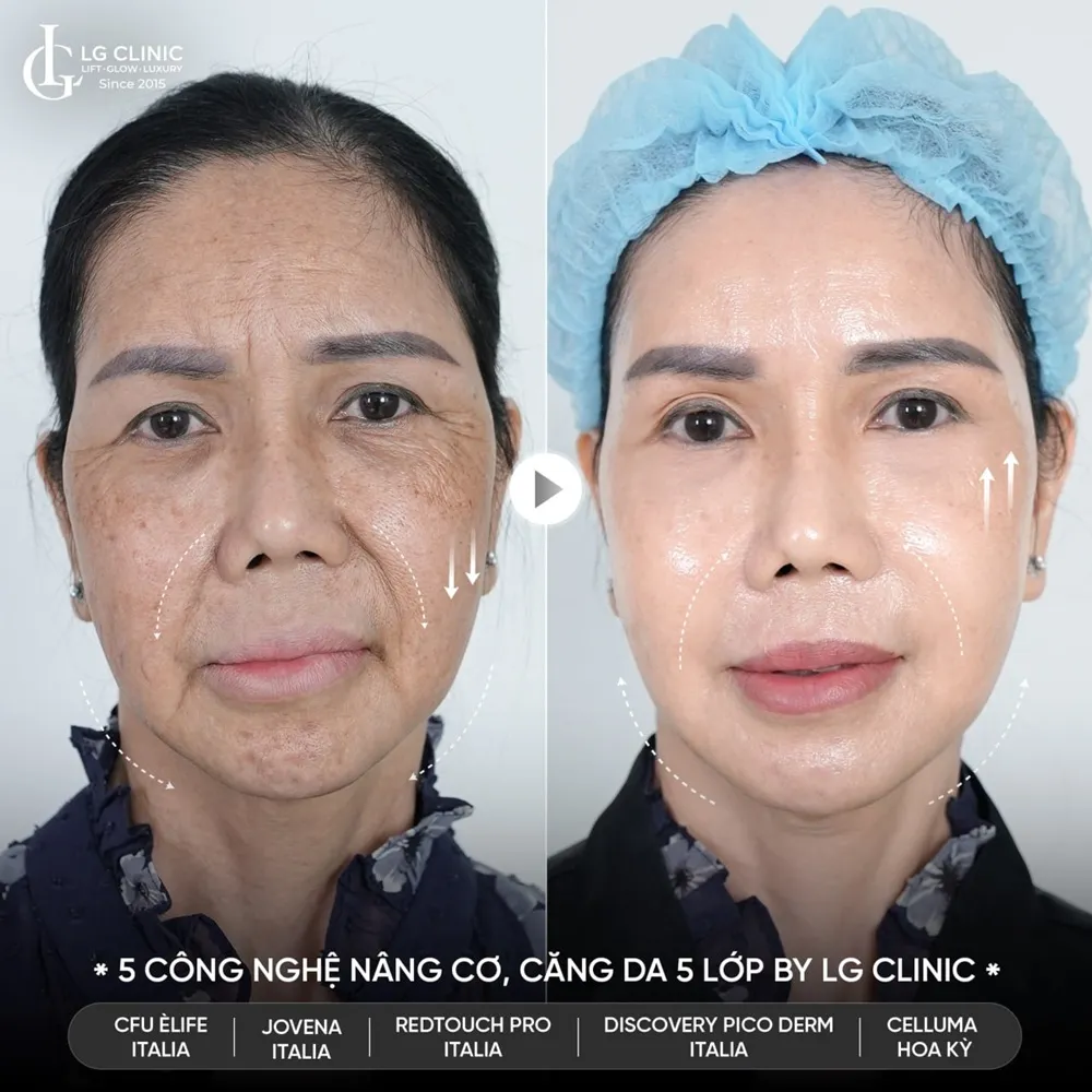 Hình ảnh ba trẻ hóa khuôn mặt