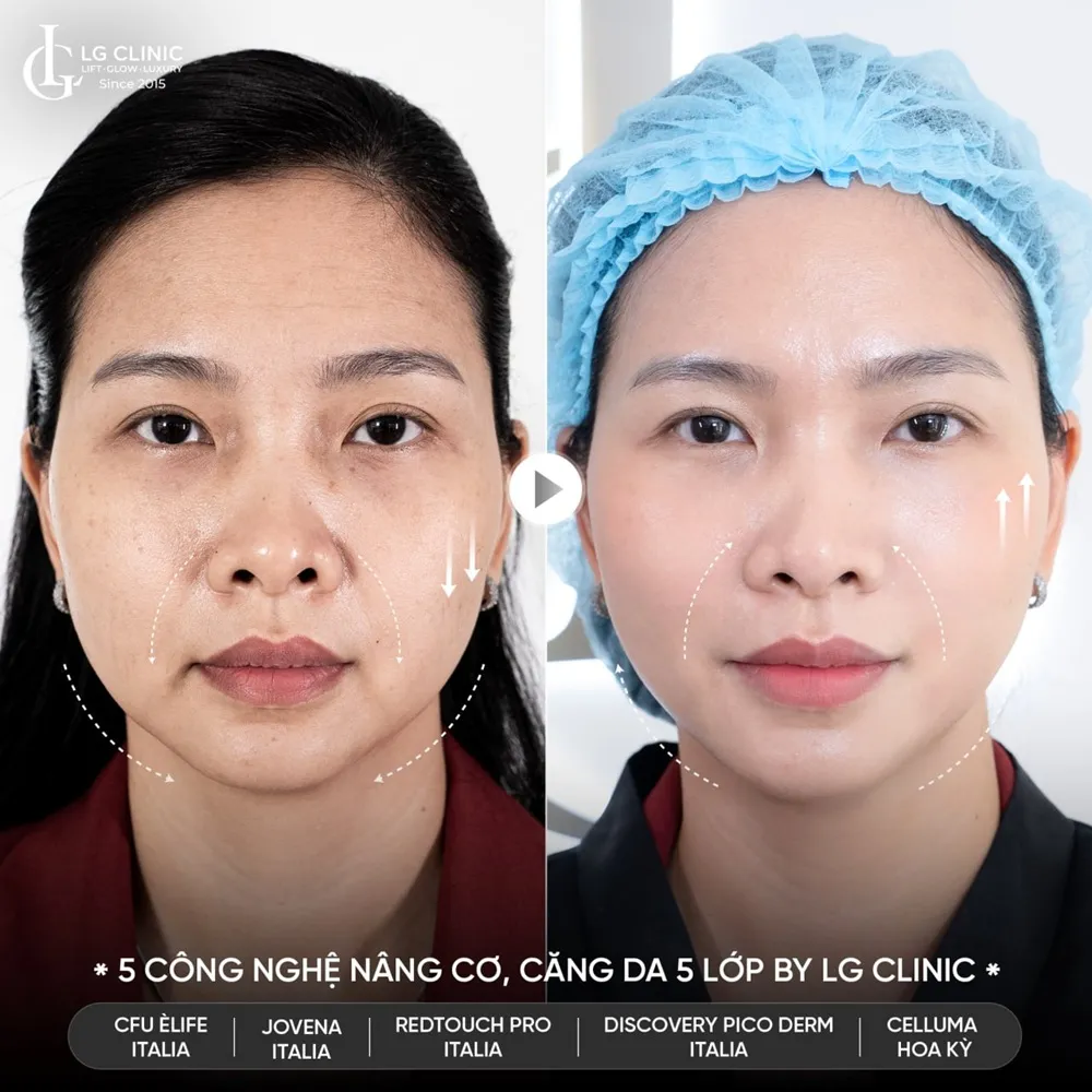 Hình ảnh ba trẻ hóa khuôn mặt