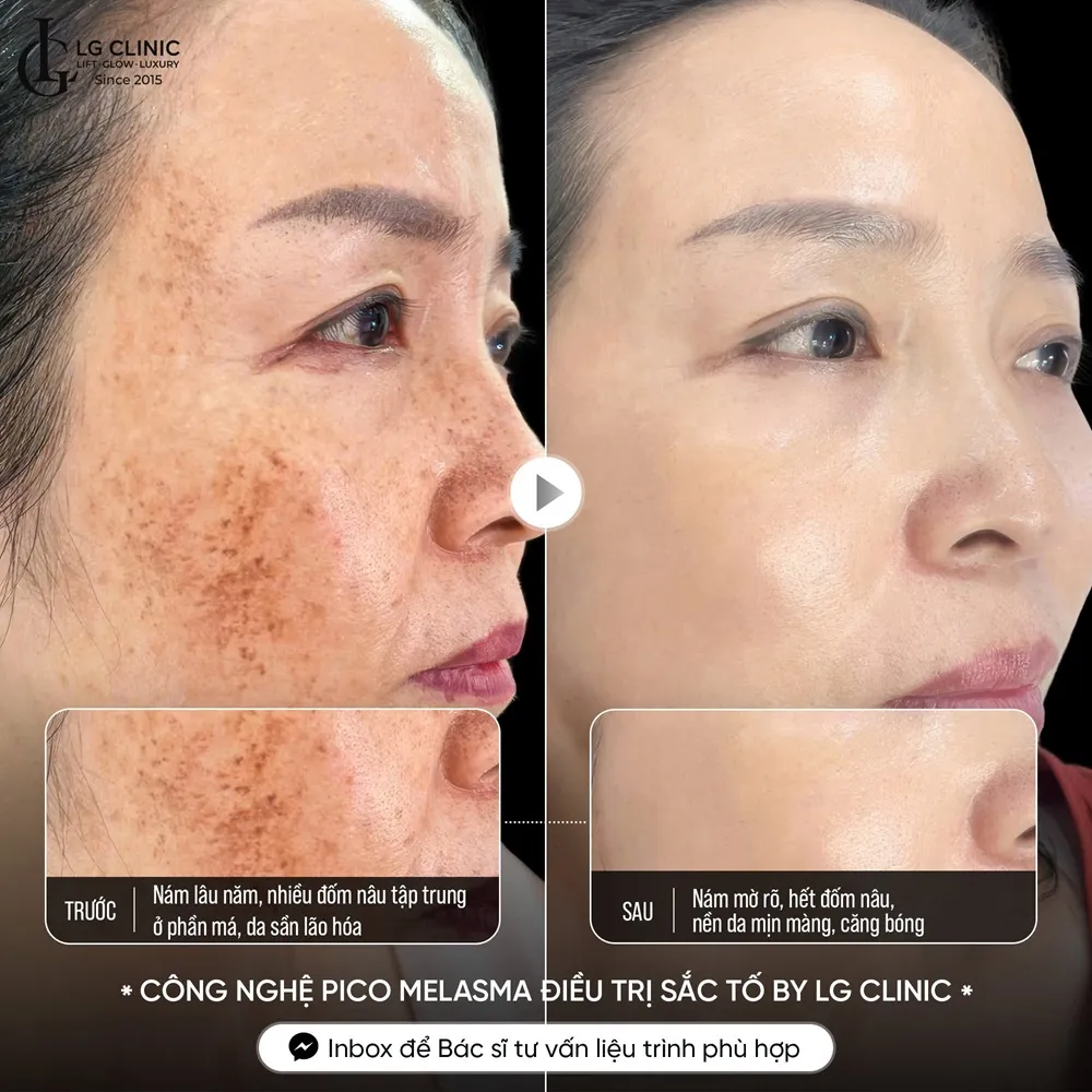 Hình ảnh ba trị nám da